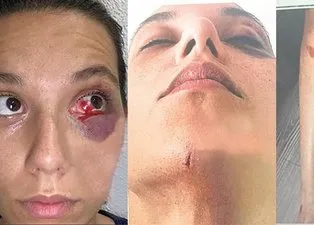 Ozan Güven'in darbettiği Deniz Bulutsuz'un yeni fotoğrafları dehşete düşürdü!