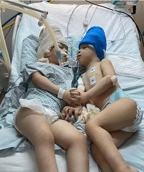 Tarihe geçen ameliyat: Yapışık ikizleri sanal gerçeklik ayırdı