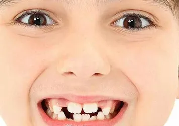 Çocuklarda ayrık diş normal